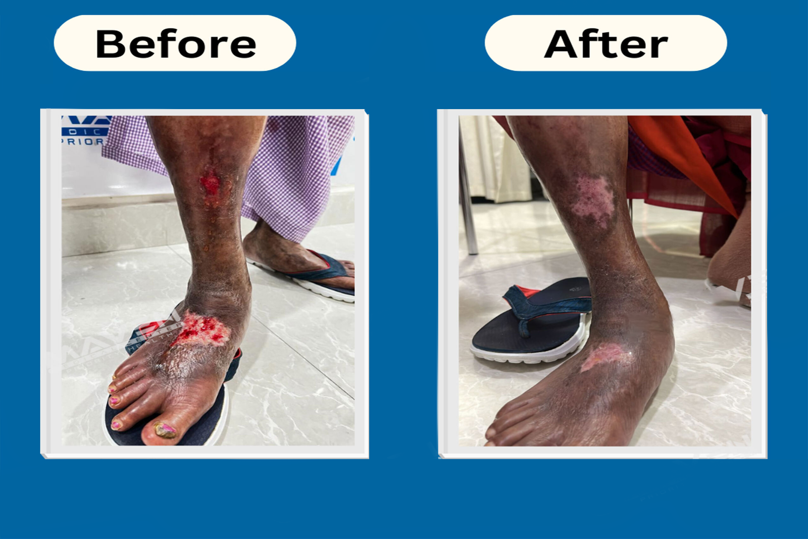Varicose vein care