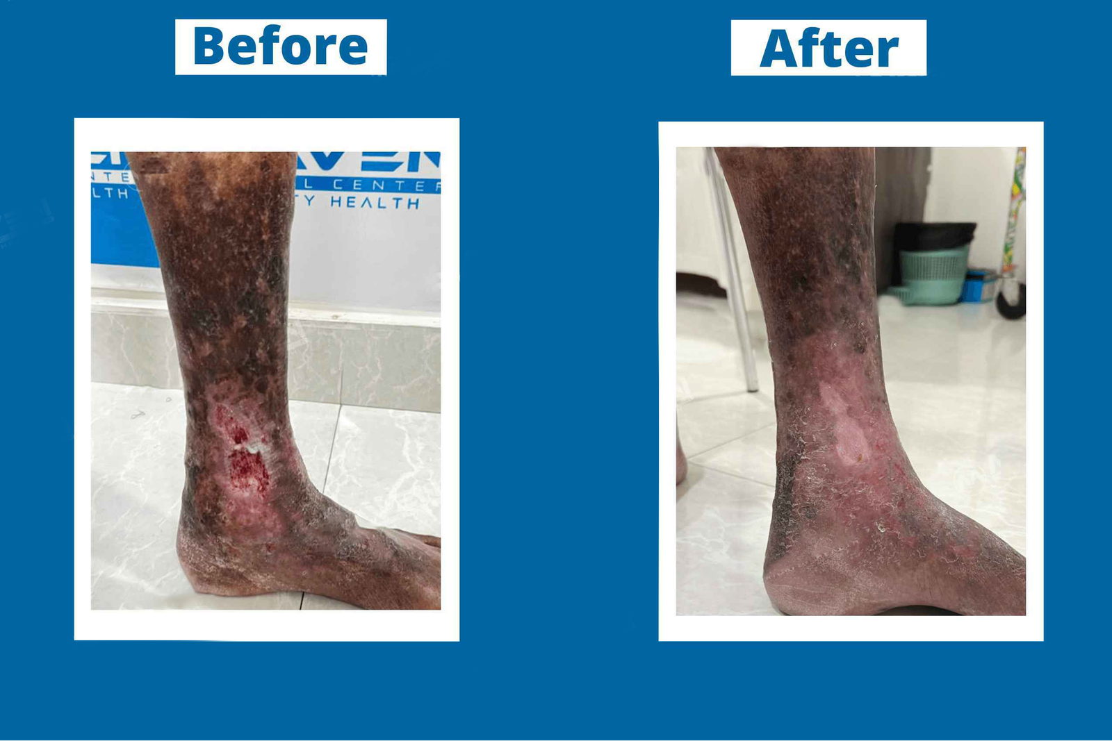 Wound and limb care