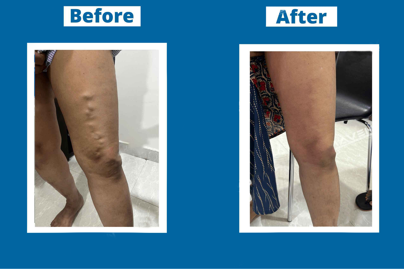 Vascular treatment follow-up