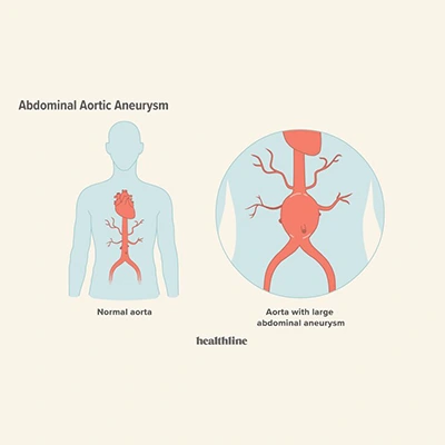 Aortic aneurysm surgery care