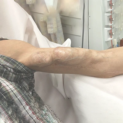 AV fistula care