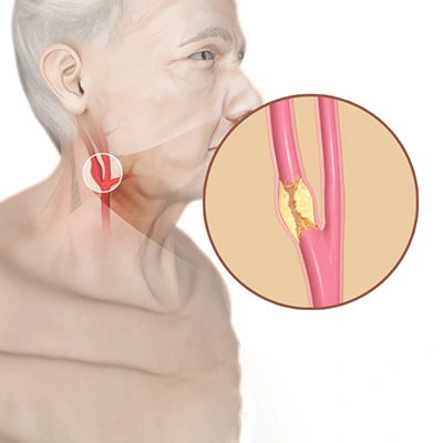 Carotid artery disease care