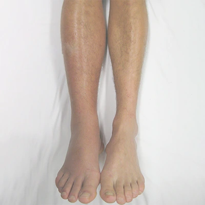 Deep vein thrombosis care