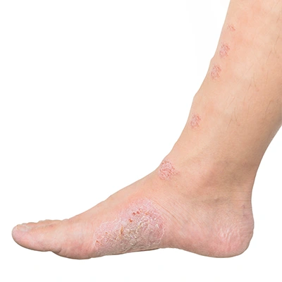 Diabetic foot care