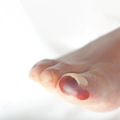 Gangrene and limb care